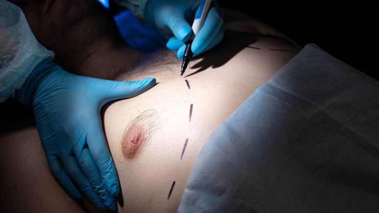 ژنیکوماستی