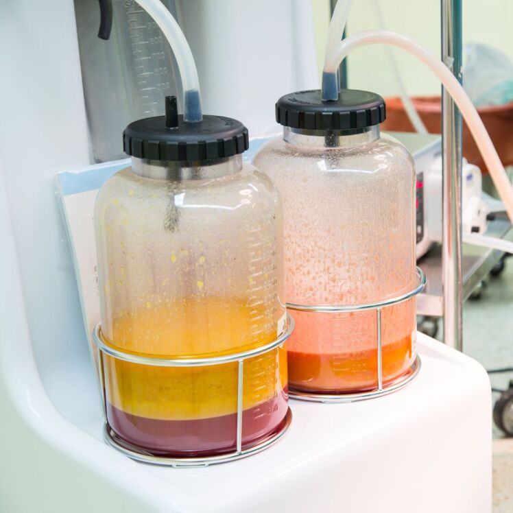 لیپوساکشن چه خطرات و عوارضی به دنبال دارد؟ لیپوساکشن بهتر است یا ابدومینوپلاستی؟!!| دکتر آراز معین متخصص جراحی عمومی ، لاپاراسکوپی و زیبایی