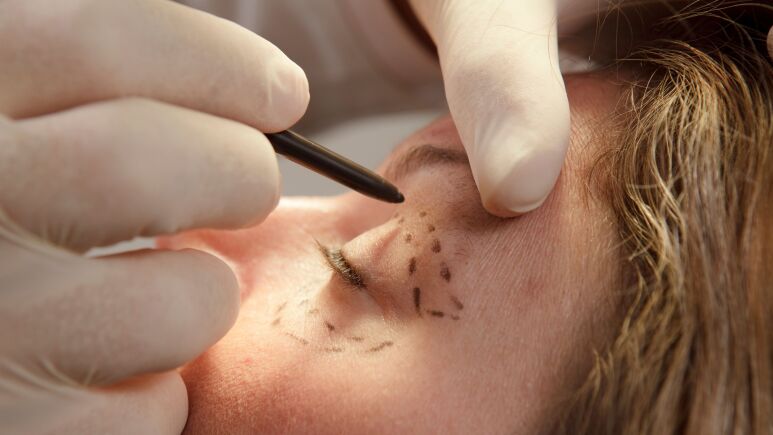 بلفاروپلاستی