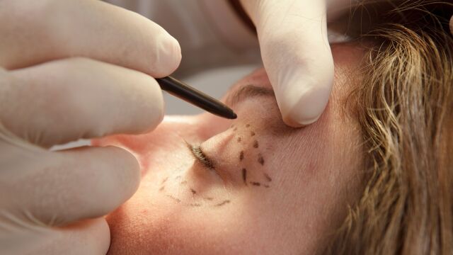 بلفاروپلاستی و بایدها و نبایدهای آن!!! | دکتر آراز معین متخصص جراحی عمومی ، لاپاراسکوپی و زیبایی