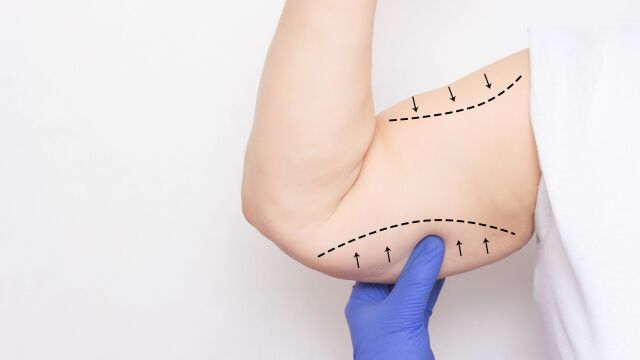 هرآنچه از جراحی لیفت بازو باید بدانید!! | دکتر آراز معین متخصص جراحی عمومی ، لاپاراسکوپی و زیبایی | بهترین جراح مراغه