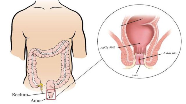شقاق یا فیشر مقعدی چیست؟علائم و راه های درمان!! | دکتر آراز معین متخصص جراحی عمومی ، لاپاراسکوپی و زیبایی | بهترین جراح مراغه