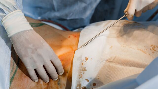 مقایسه لیپوساکشن و لیپوماتیک و مزایای لیپوماتیک که نمیدانستید!!| دکتر آراز معین متخصص جراحی عمومی ، لاپاراسکوپی و زیبایی